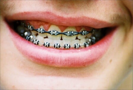4 Tips to Keep Your Traditional Braces Clean